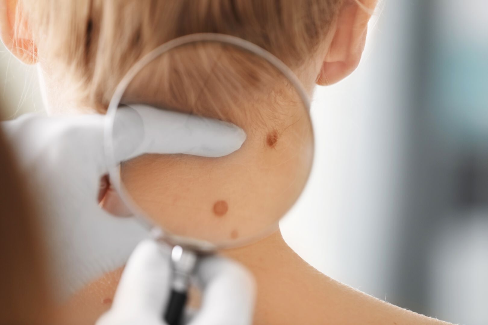 MELANOMA clinical guideline