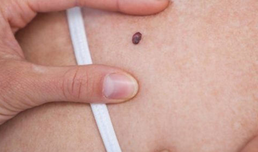 Studiu de acuratete al evaluarii riscului de cancer de piele cu ajutorul aplicatiilor inteligente