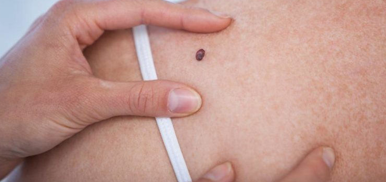 Studiu de acuratete al evaluarii riscului de cancer de piele cu ajutorul aplicatiilor inteligente