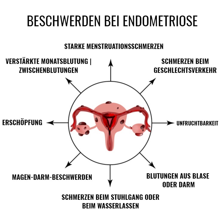 Die Symptome einer Endometriose sind sehr vielfältig