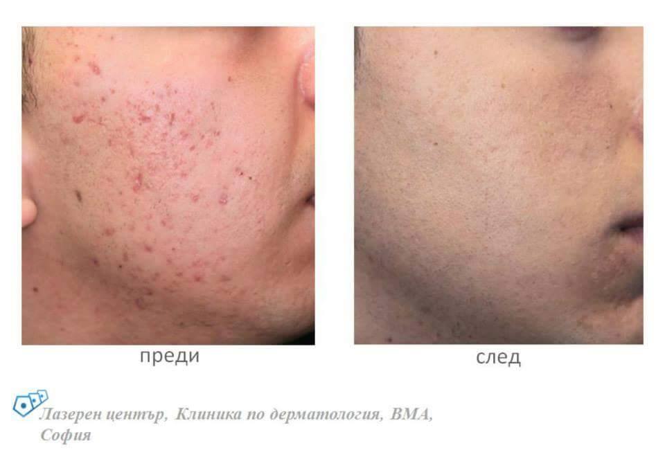 Безплатни прегледи за акне във ВМА