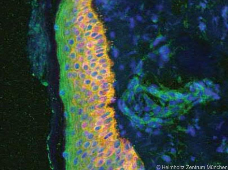 Antikörper hemmt auch "guten" Botenstoff bei Psoriasis