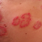 Die Schuppenflechte (Psoriasis) - Ursachen, Behandlung und neue Therapieansätze