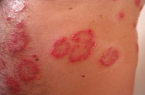 Die Schuppenflechte (Psoriasis) - Ursachen, Behandlung und neue Therapieansätze