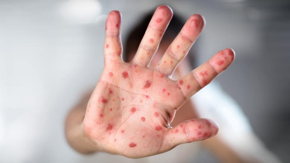 Морбили (Measles)
