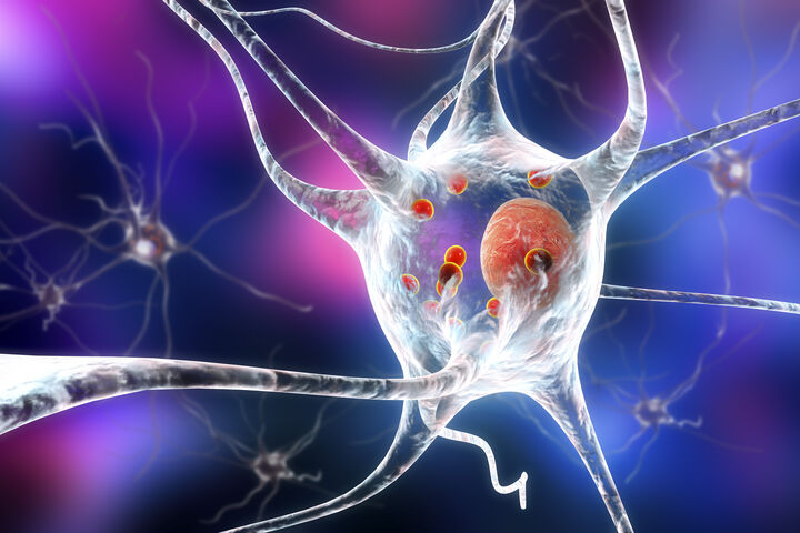 Möglicher Therapieansatz bei Parkinson identifiziert
