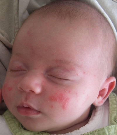 Pediatric acne - the many faces and challenges