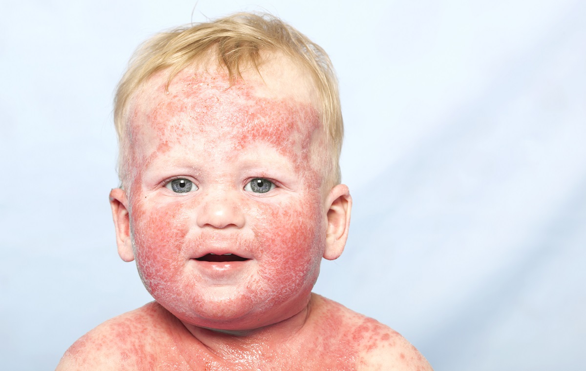 атопичен дерматити при бебе