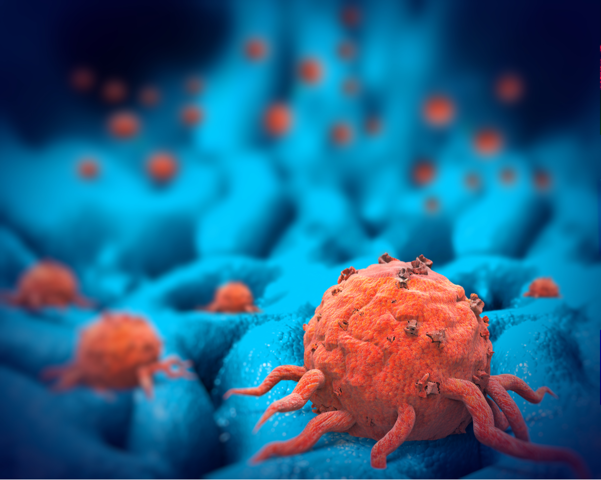 Therapieresistentes Prostatakarzinom kann an einem Biomarker erkannt werden