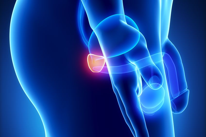 Prostatakarzinom: genauere Früherkennung möglich