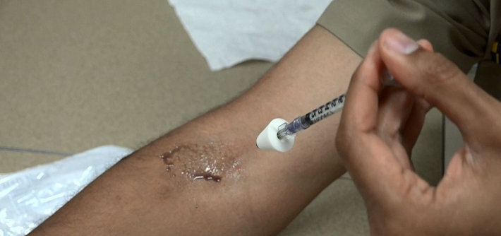 Bacterial therapy for eczema shows promise in new study