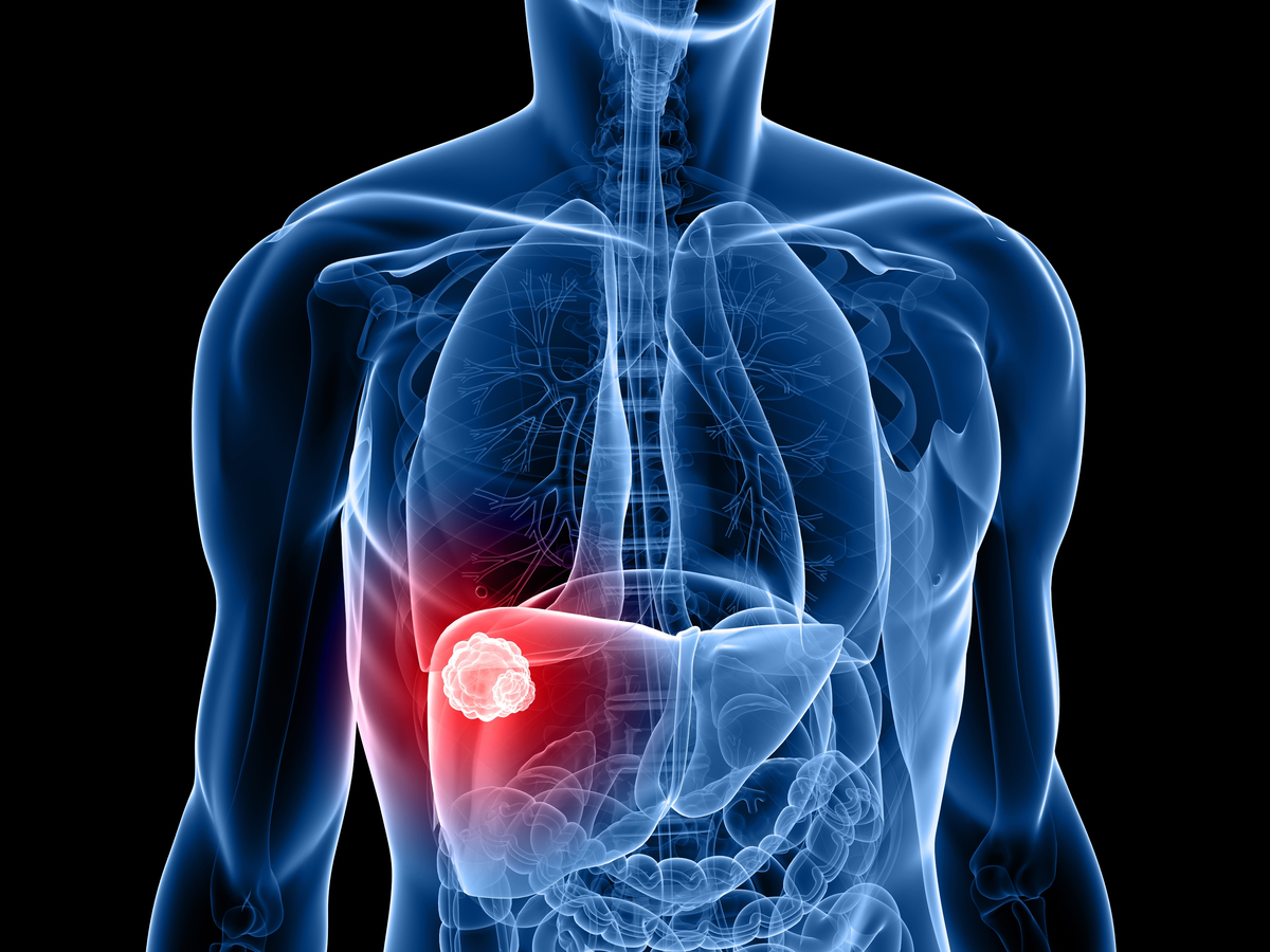 Leberkrebs: Neuer Biomarker für Leberversagen nach operativer Teilentfernung gefunden