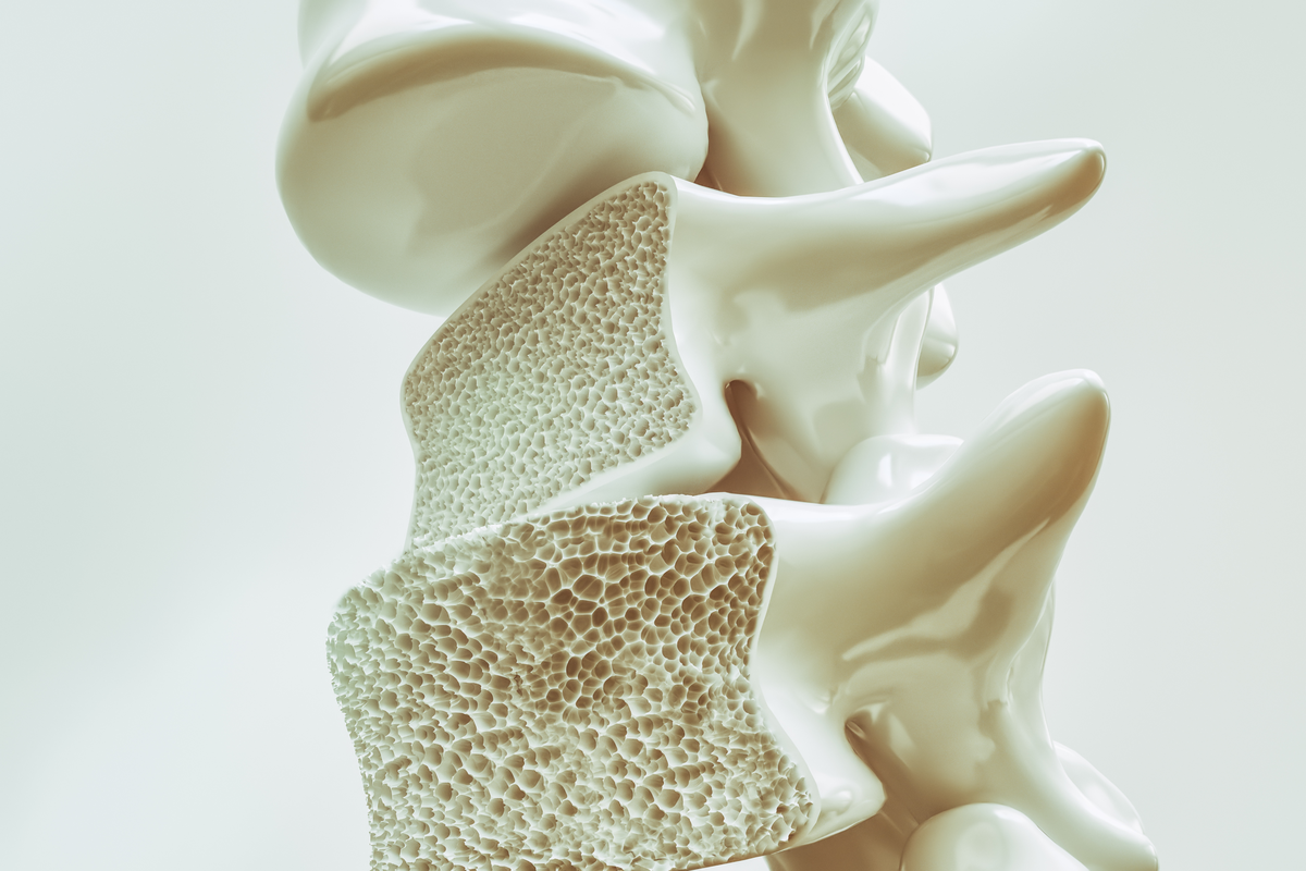 Osteoporose, Knochenschwund