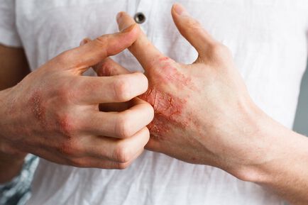 Inflammatorische Hautkrankheiten: alles Immunologie
