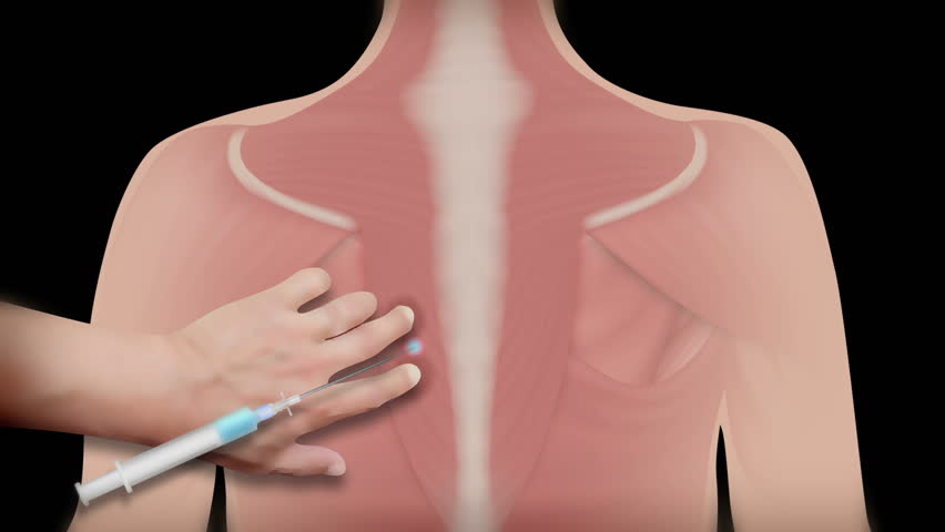 Trigger point обезболяване