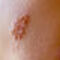 Herpes Zoster im Überblick