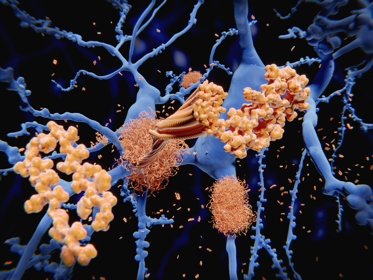 Herber Rückschlag für die Alzheimer-Forschung