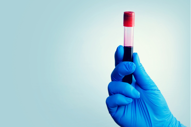 Liquid Biopsy als Zukunftshoffnung im Kampf gegen Krebs