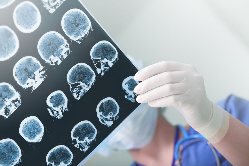 Europäischer Epilepsiekongress in Wien: Fortschritte bei Entschlüsselung der Ursachen, neue Therapien