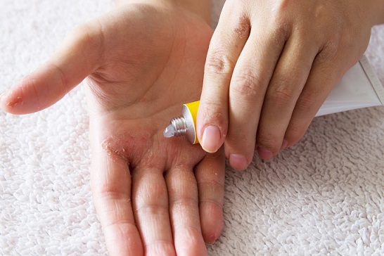 The Cost of Psoriasis in Patients under Conventional Systemic Therapy or Biologic: The Results of a Retrospective Analysis Carried out in an Italian Center