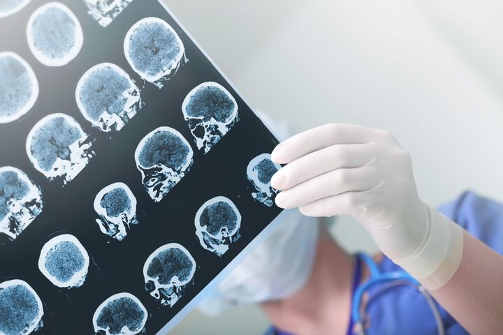 Hirntumoren: Spezielle molekulare Profilerstellung könnte präzisere Prognose und Therapie ermöglichen