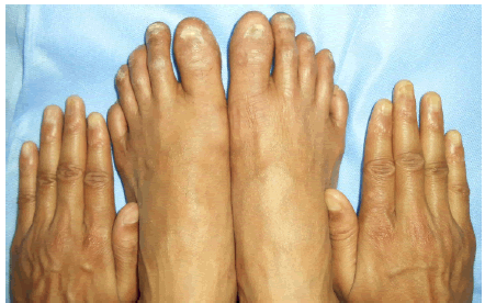 Nail Changes in Chilblains Mimicking Lichen Planus