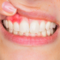 CYTOKINE PROFILE IN CRREVICULAR FLUID OF CHILDREN WITH PLAQUE-INDUCED GINGIVITIS – EFFECT OF TOOTH PASTE AND BULGARIAN PROPOLIS