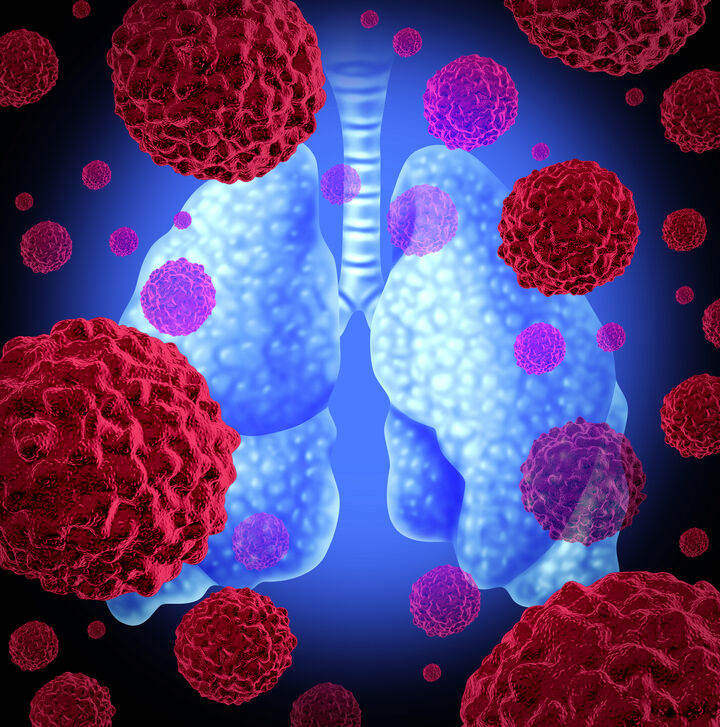 Lungenkrebs: Immuntherapie kommt bei fast jedem Patienten zum Einsatz – und bringt Überlebensvorteil