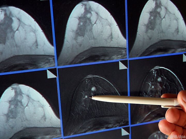 Boost-Bestrahlung bei Brustkrebs verhindert langfristig ein Lokalrezidiv