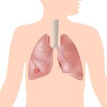 Früherkennung seltener Lungenerkrankungen bis Lungenkrebs, ist das möglich?