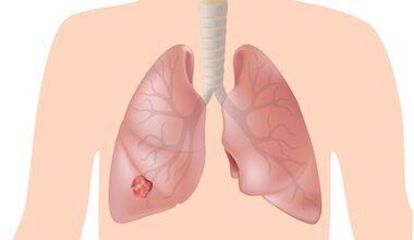 Früherkennung seltener Lungenerkrankungen bis Lungenkrebs, ist das möglich?