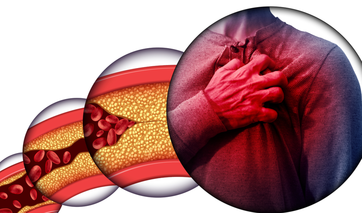 Arteriosklerose Ursachen und Diagnose CredoWeb