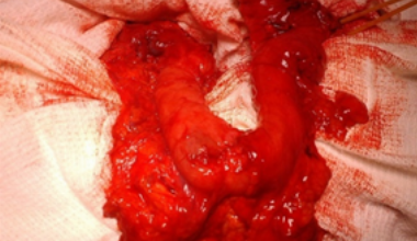 Esophagogastroplasty as the second step of surgical treatment