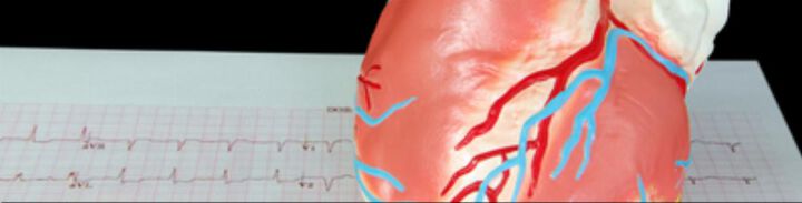 Herzinfarkt: Studie der Medizinischen Universität Innsbruck identifiziert neuen Risikofaktor