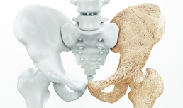 Osteoporose: Früherkennung und Prävention (Video)