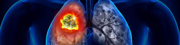Lungenkrebs-Früherkennung: Screeningprogramm für Risikogruppen gefordert