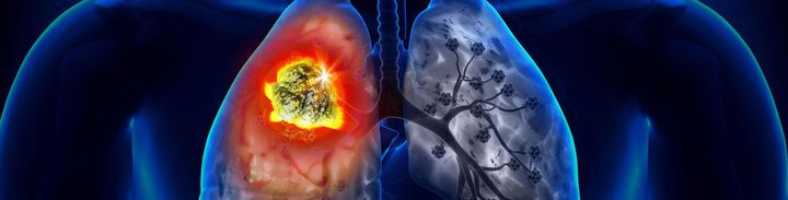 Lungenkrebstagungen in Wien: Internationale Experten suchen nach optimalen Strategien