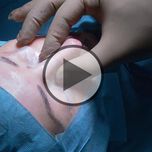 Einzigartig in Österreich: Nasenkorrektur mit Hilfe von Ultraschallwellen - Video