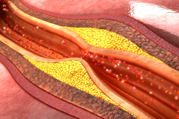 Sirtuine: Eine vielversprechende Therapieoption bei Verschlusskrankheiten der Blutgefäße