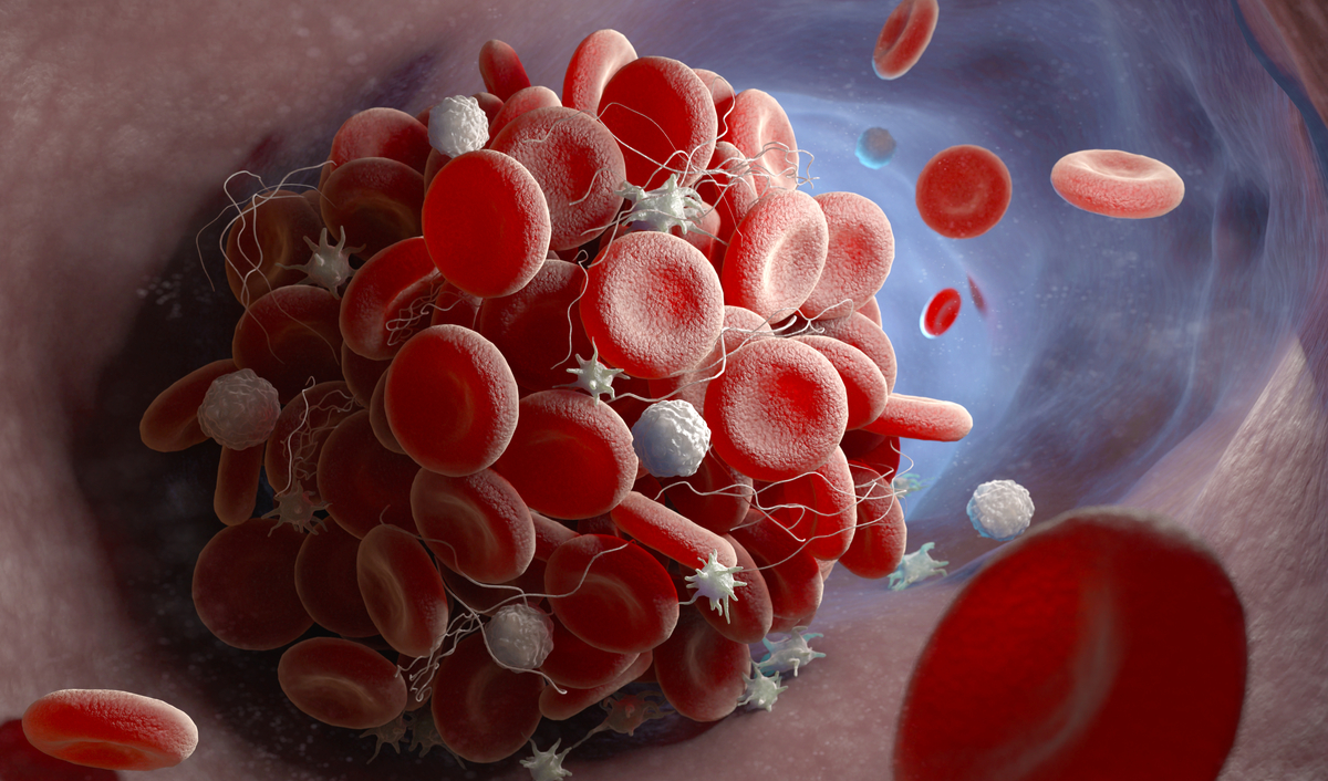 Welt-Thrombose-Tag am 13. Oktober: Thrombosen sind zweithäufigste