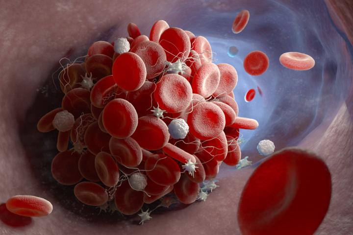 Welt-Thrombose-Tag am 13. Oktober: Thrombosen sind zweithäufigste Todesursache bei Krebs
