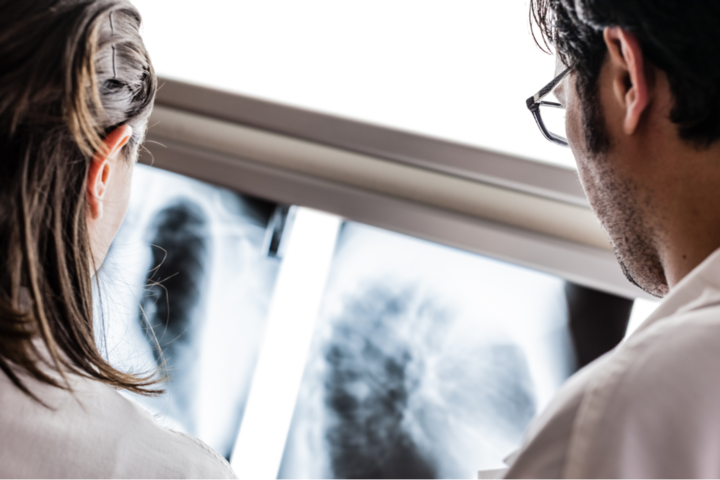 Lungenkrebs-Screening könnte über 1.000 Leben im Jahr retten  