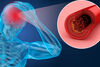 COVID-19 und Atherosklerose: „Der Schlaganfall ist eine seltene Folge der neuen Corona-Infektion“