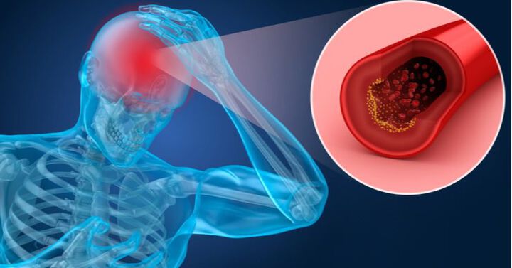 COVID-19 und Atherosklerose: „Der Schlaganfall ist eine seltene Folge der neuen Corona-Infektion“