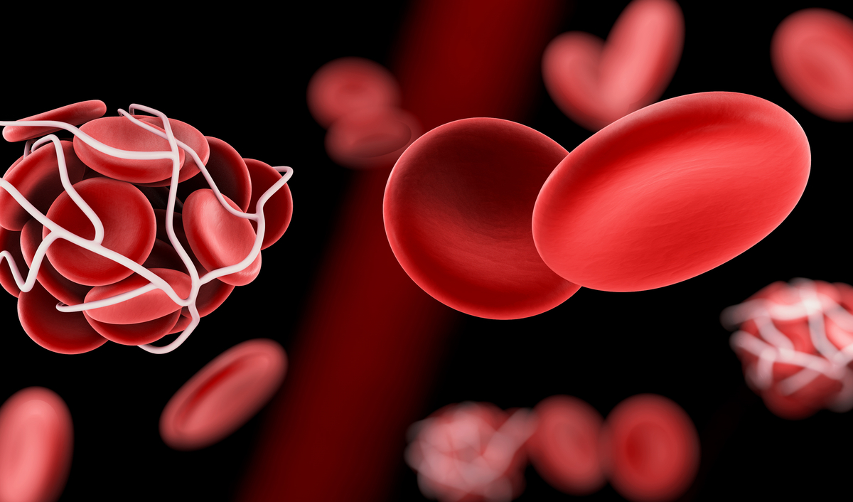 Welcher Krebs Löst Thrombose Aus