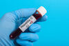 Leberkrebs nach Hepatitis C: Neues Tool zur Risikoeinschätzung entwickelt