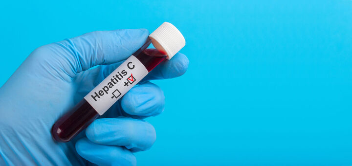 Leberkrebs nach Hepatitis C: Neues Tool zur Risikoeinschätzung entwickelt