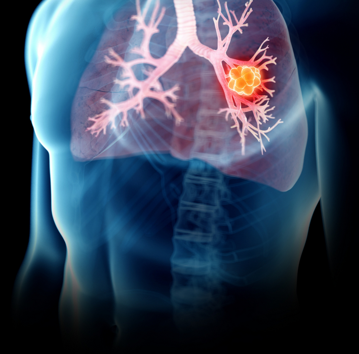 Unterschiedliche Subtypen beim Kleinzelligen Lungenkrebs definiert