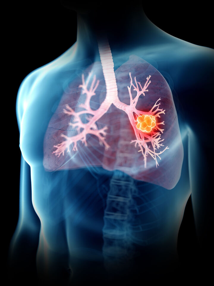 Unterschiedliche Subtypen beim Kleinzelligen Lungenkrebs definiert