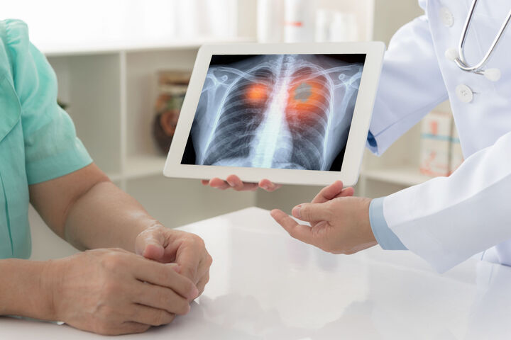 Kleinzelliger Lungenkrebs: Neuer Ansatz für personalisierte Therapie
